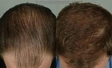 Hair restoration procedure before and after results