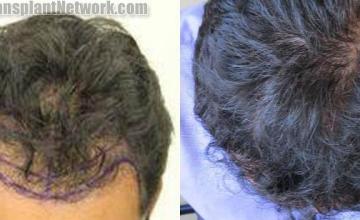 Hair transplantation surgery before and after images