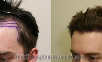 Before and after hair transplant procedure images