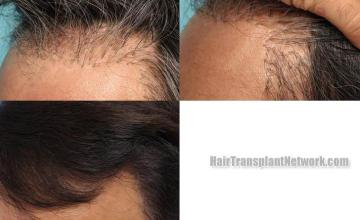 Hair transplantation surgery before and after pictures