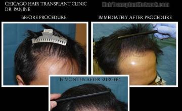 Hair transplant procedure before and after images