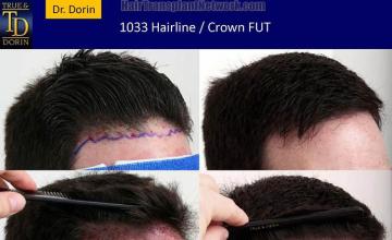 Hair restoration procedure before and after pictures