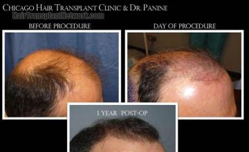 Hair transplantation surgery before and after photos