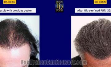 Hair restoration procedure before and after results