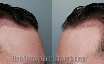 Hair restoration procedure immediate postoperative