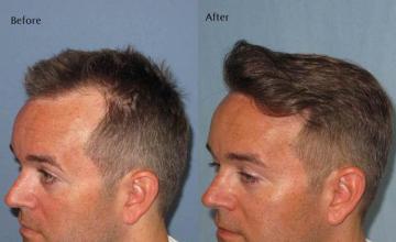 Hair transplantation surgery before and after images