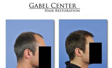 Hair restoration procedure before and after results