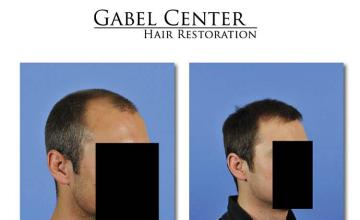 Before and after surgical hair restoration images