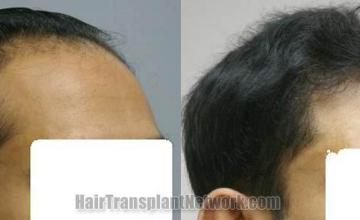 Hair transplant procedure before and after images