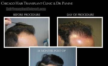 Hair restoration procedure after result images