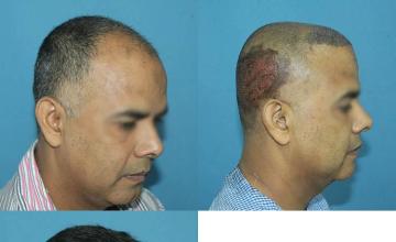 Hair restoration procedure after result images