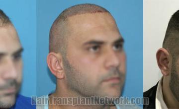 Hair restoration procedure before and after results