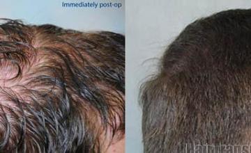 Hair restoration procedure results