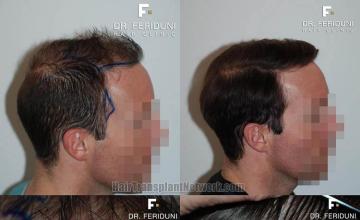 Hair transplantation procedure before and after photos