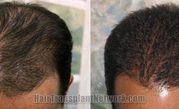 Top view - Before and after hair transplantation photos