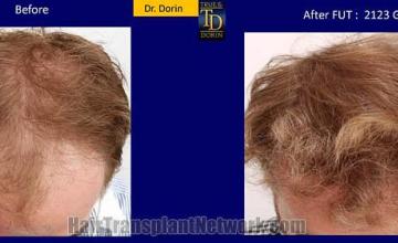 Hair restoration procedure before and after results