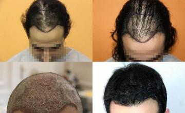 Hair restoration procedure before and after results