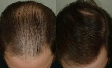 Hair transplantation surgery before and after photos