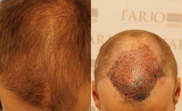 Top view before and after hair restoration results