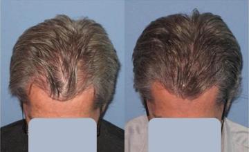 Hair restoration procedure before and after results