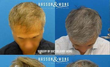 Before and after hair restoration procedure images