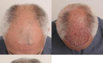 Hair transplantation surgery before and after images