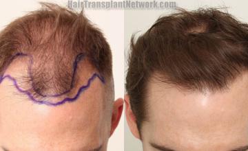 Before and after hair restoration procedure images