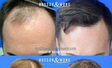 Before and after hair restoration procedure images