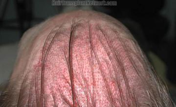 Top immediate postoperative hair transplant image