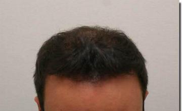 Hair restoration procedure results