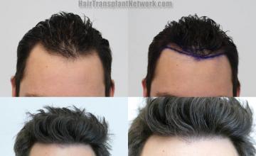 Hair transplantation surgery before and after images