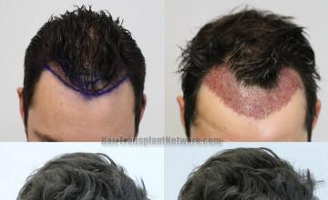 Top view before and after hair restoration results