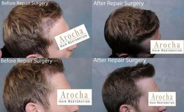 Hair transplantation surgery before and after photos