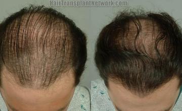 Top view before and after hair restoration results