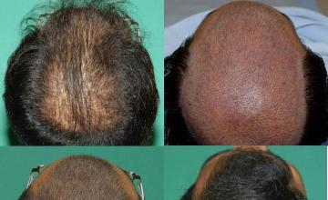 Before and after hair transplant procedure images