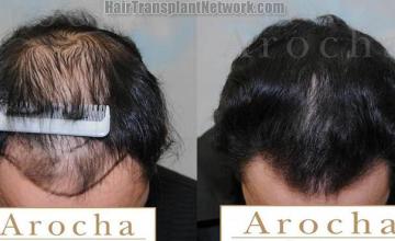 Before and after hair restoration procedure images