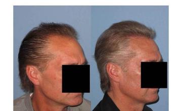 Right view before and after hair replacement surgery