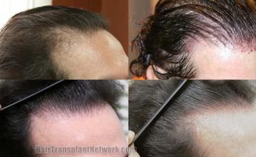 Before and after hair transplant procedure images