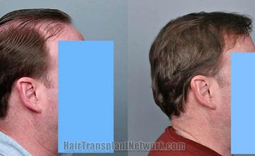 Hair restoration procedure before and after results