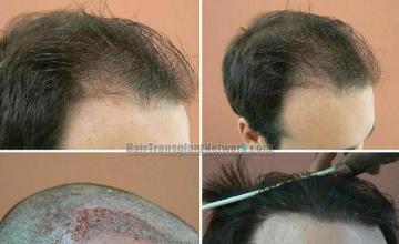 Hair transplantation surgery before and after images