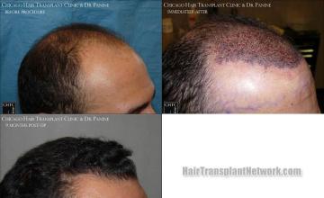 Hair transplantation surgery before and after images