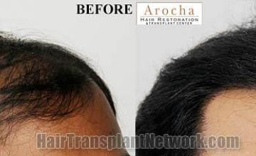 Hair transplantation surgery before and after images