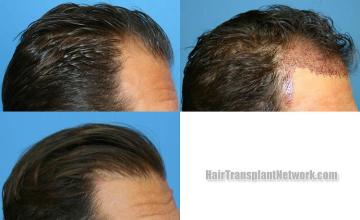 Hair restoration procedure before and after results
