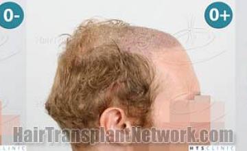 Hair transplantation surgery before and after images