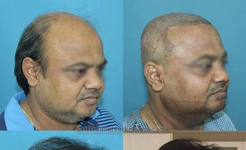 Hair transplantation procedure before and after results