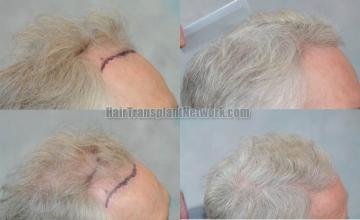 Hair transplantation procedure before and after results