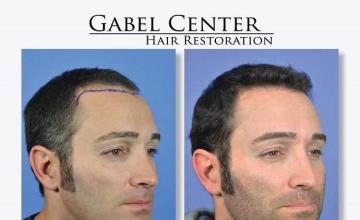 Hair transplantation surgery before and after images