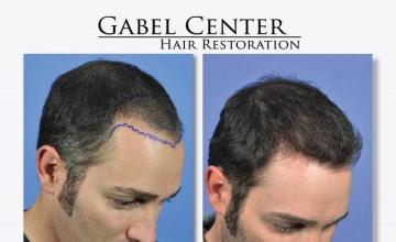 Hair restoration surgery before and after photos