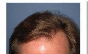 Hair restoration procedure results