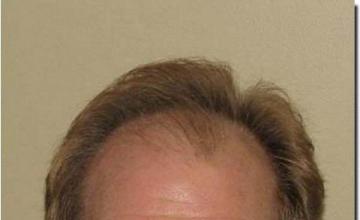 Hair restoration procedure results